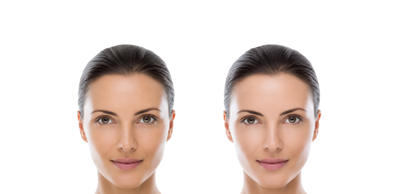Before and after results